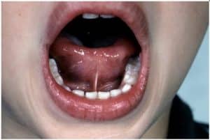Oral Injury: Does a Torn Frenulum Always Point to Abuse?